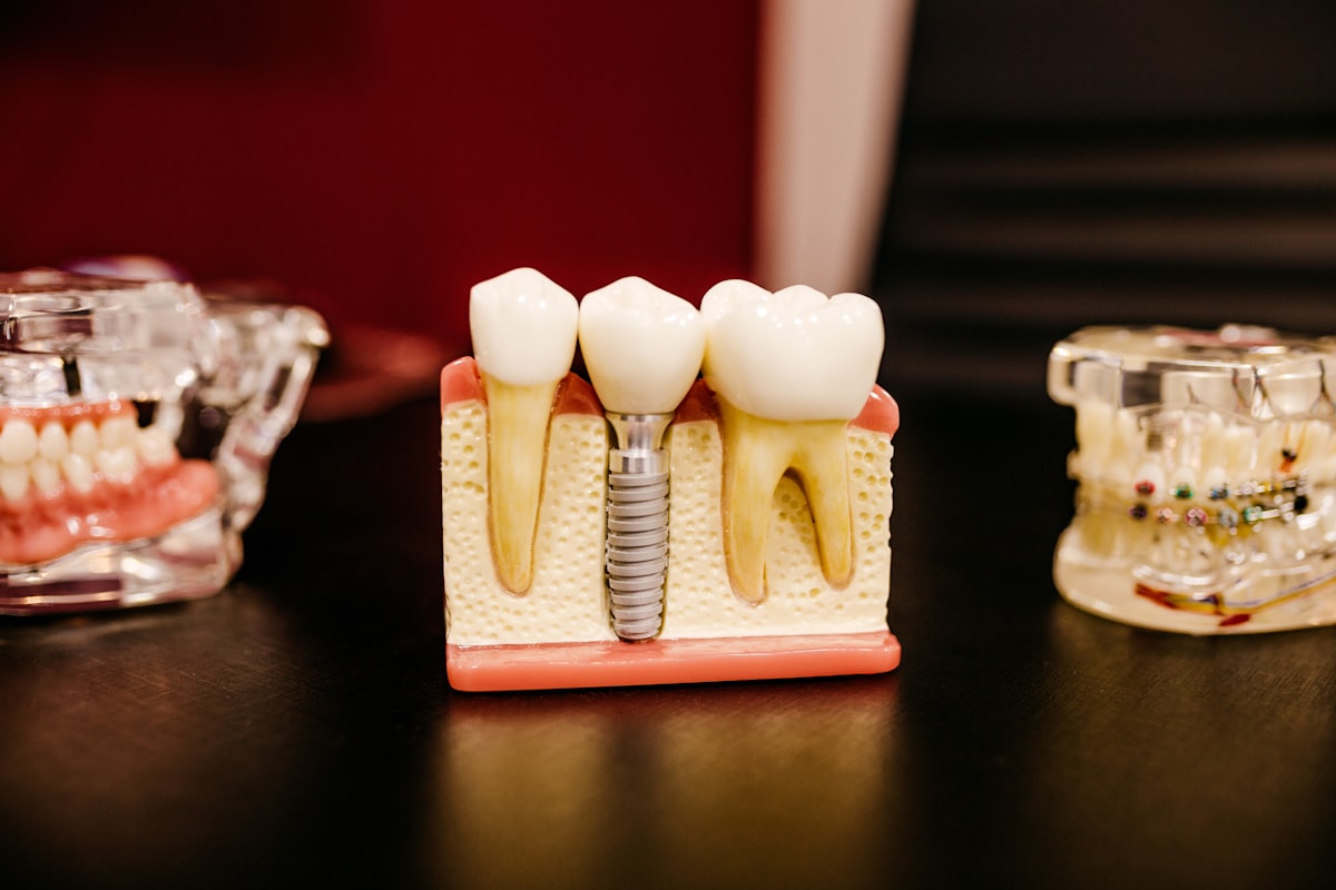 Dental implant model showing how an implant fits among teeth