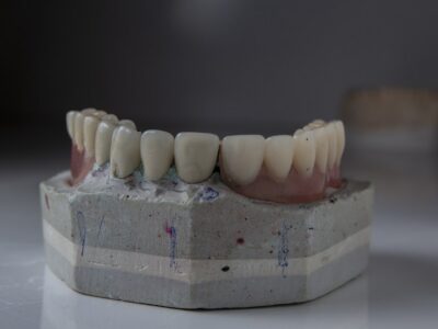 Dental cast with restored teeth on a work surface