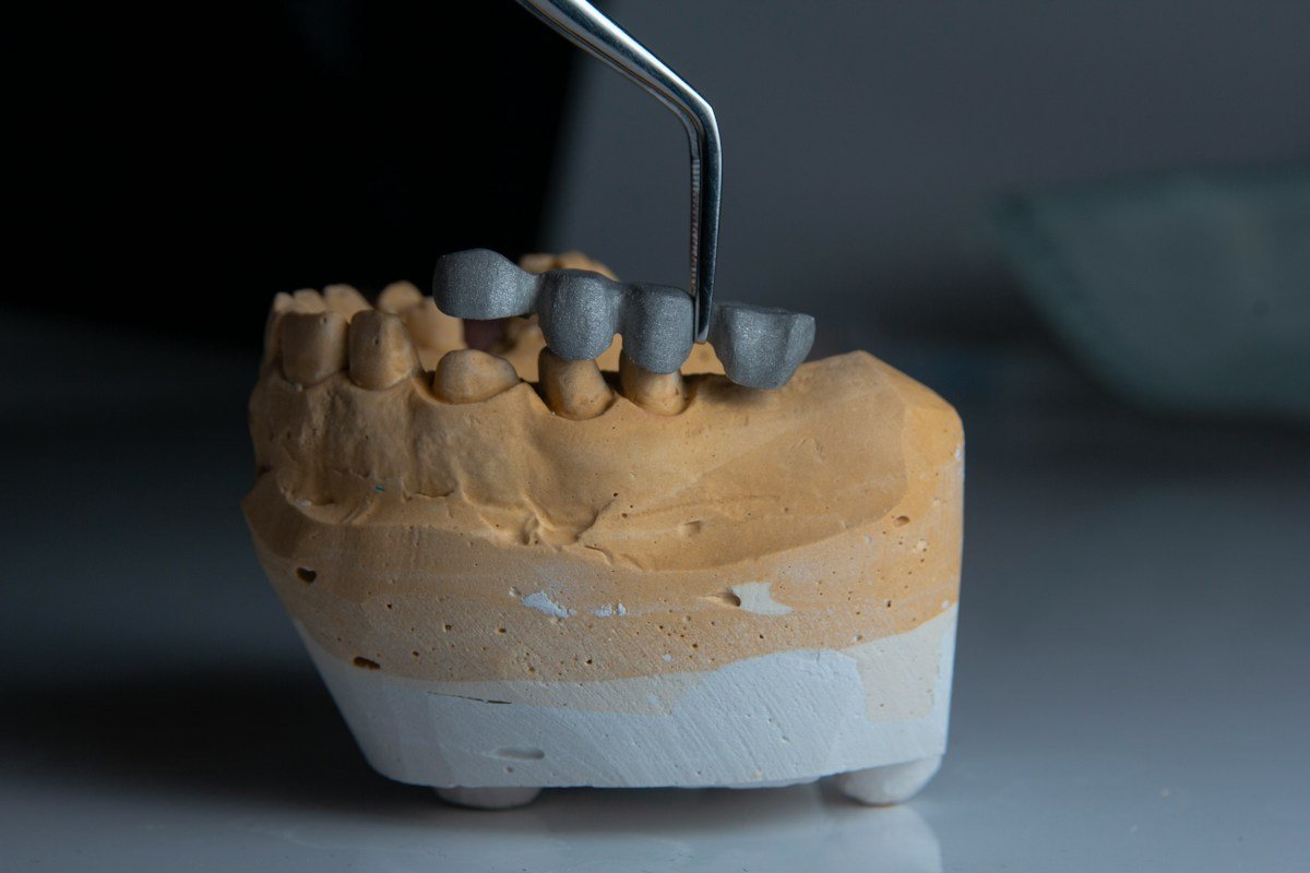 Dental lab cast with a metal restoration framework being fitted