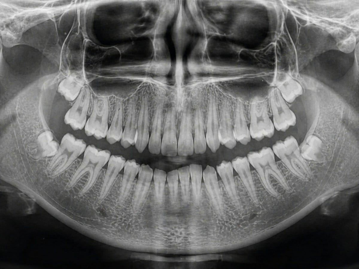 Panoramic dental X-ray showing upper and lower teeth