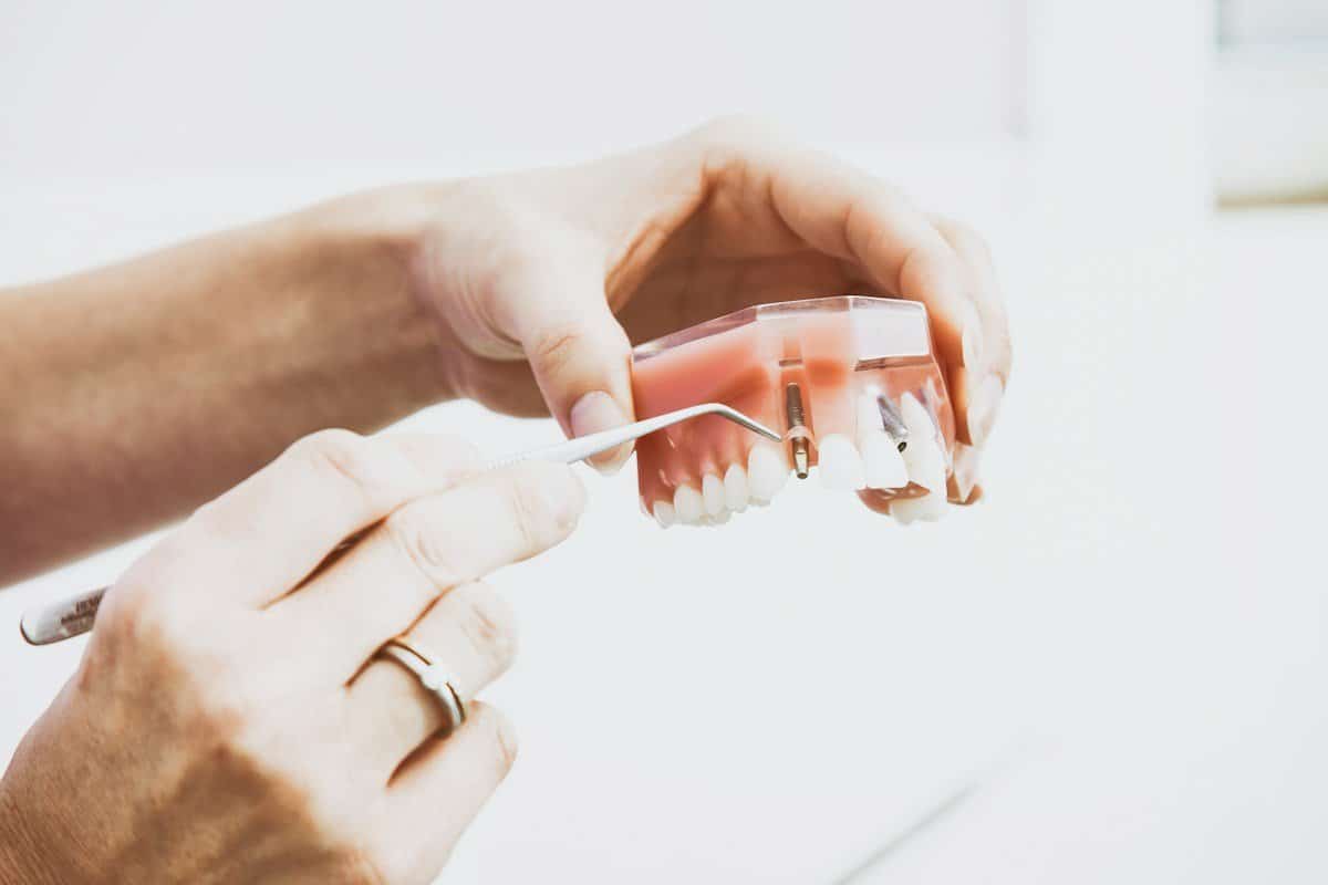 Hands holding a dental model with implant posts during a consultation
