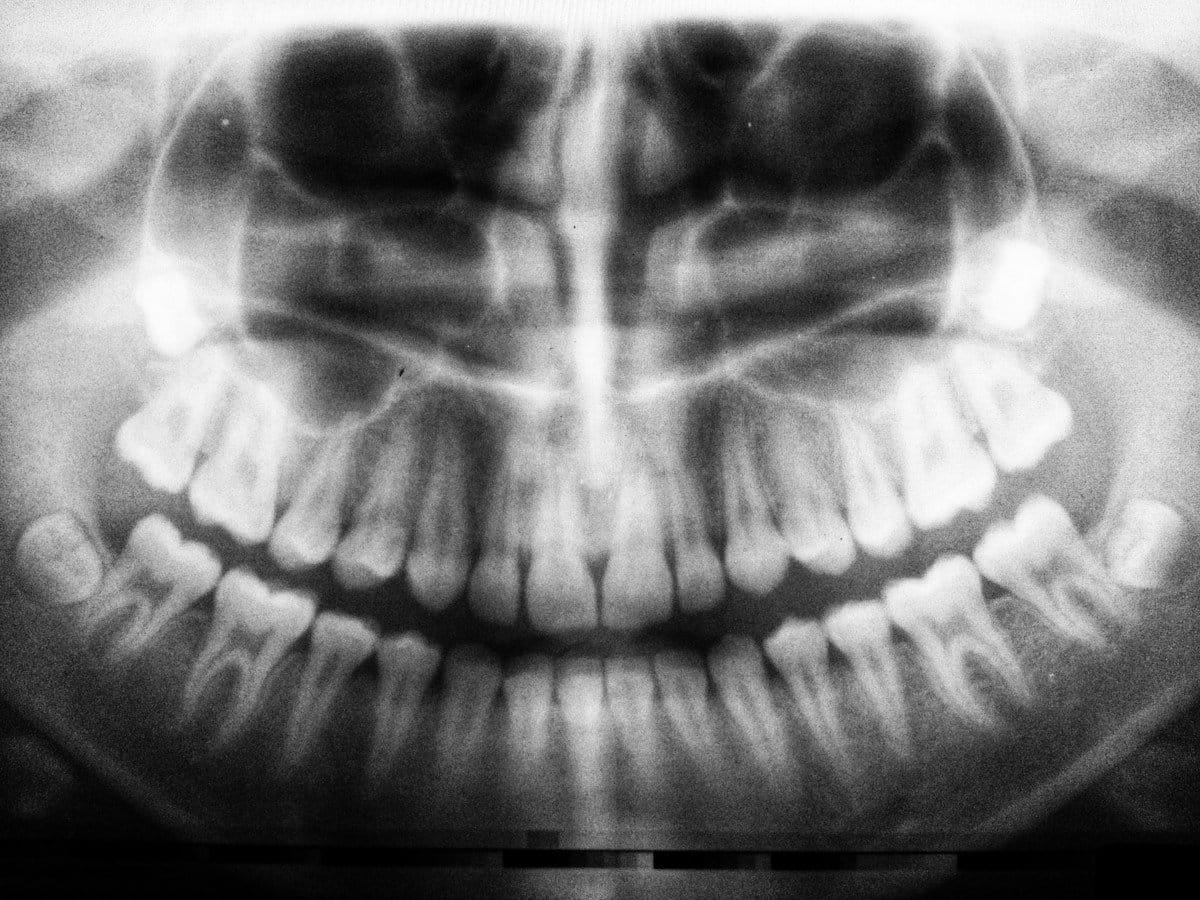 Panoramic dental X-ray, the way decay under a veneer is usually found